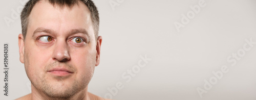 A man with strabismus squints his eyes on a white background, a banner with space for text. photo