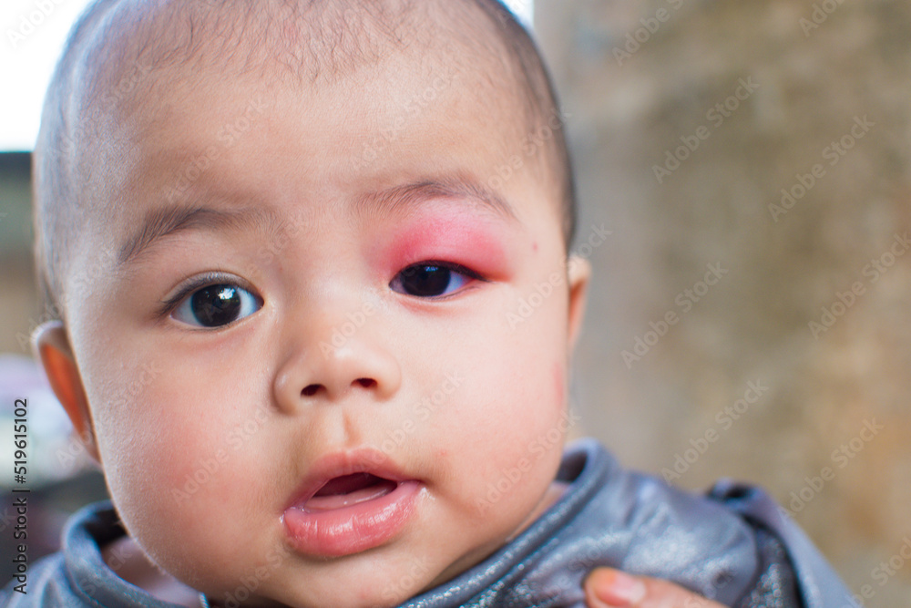 little baby infection at the eyelid caused by being bitten by insects causing swelling and redness and heat and itching little baby infection at the eyelid caused by being bitten by insects causing swelling and redness and heat and itching