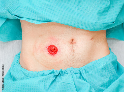 A young patient in pajamas with an open stomach, postoperative scars and a clean intestine out.. photo