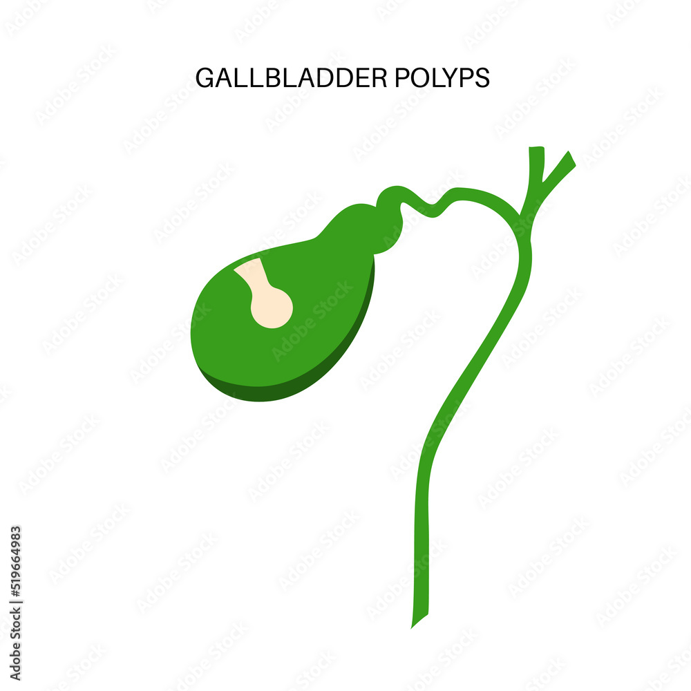 Gallbladder polyp anatomy Stock Vector | Adobe Stock