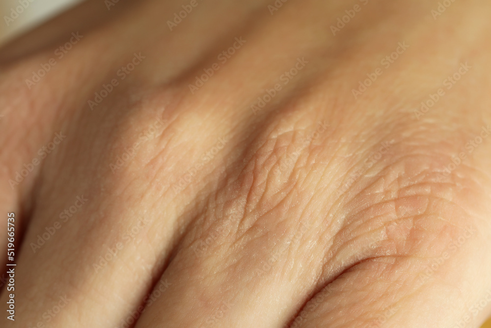 Closeup view of person with dry skin on hand