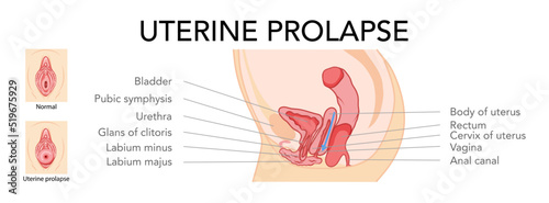 Set of uterine prolapse Female reproductive system uterus labeled in Anatomical infographic. Side view in a cut. Human anatomy internal organs location scheme flat icon. Vector medical illustration