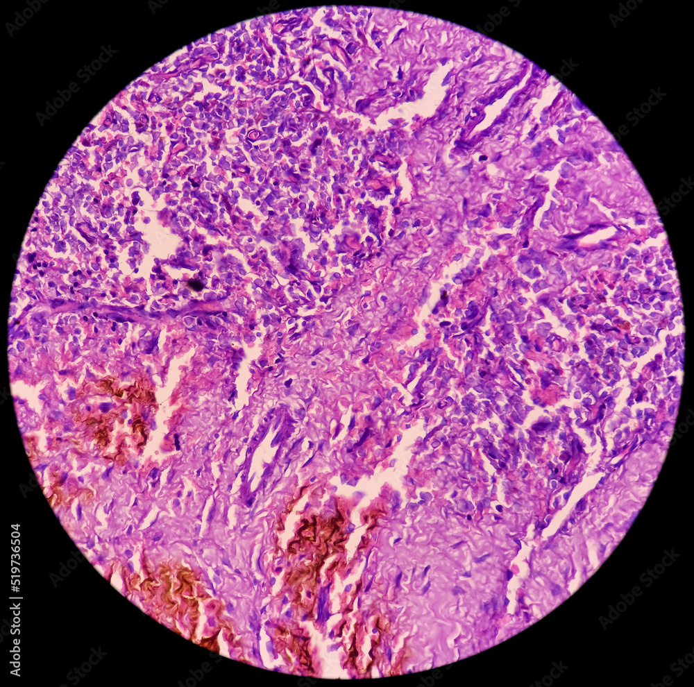 Gartner's duct cyst(biopsy) Microscopic image show cyst wall, composed