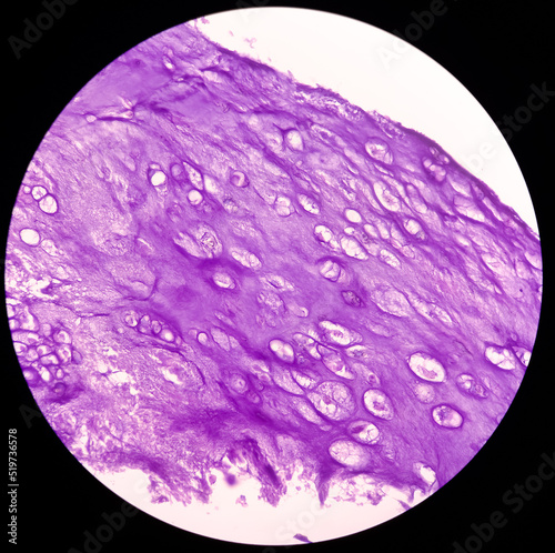 Microphotograph of bone tumor, Enchondroma, show bony tissue features of enchondroma,Benign bone tumor. photo