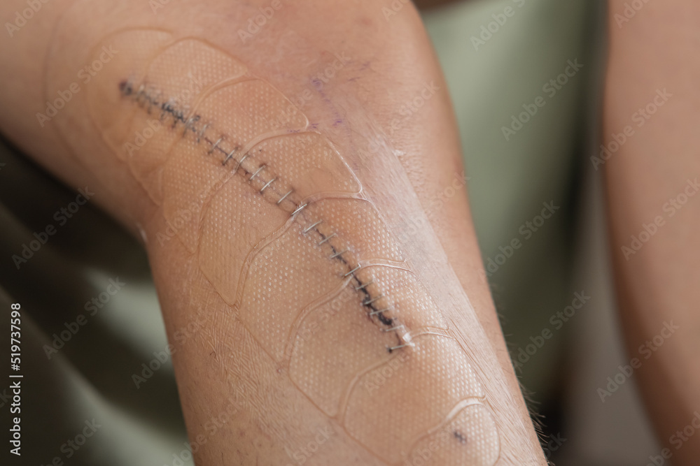 Metal staples or stitches over a fresh wound after knee surgery. Wound and stitches covered with plastic self adhesive safety cover to prevent bruises.