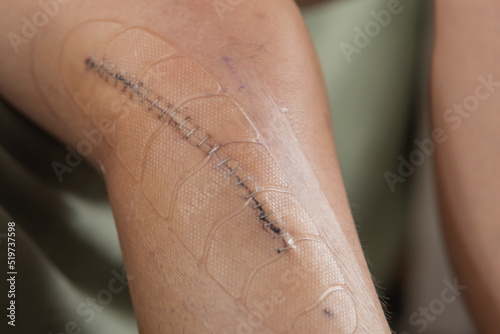 Obraz na płótnie Metal staples or stitches over a fresh wound after knee surgery. Wound and stitches covered with plastic self adhesive safety cover to prevent bruises. w salonie