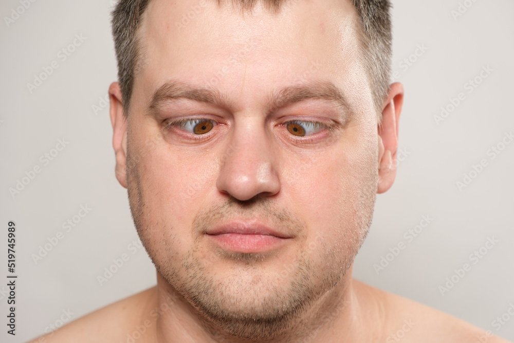 A man does exercises for the eyes, looks at the nose, brings his eyes to the center. A man does exercises for the eyes, looks at the nose, brings his eyes to the center.
