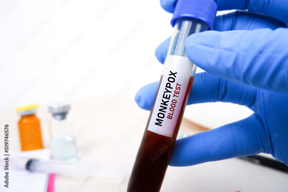 Monkeypox (MPXV) blood sample in test tube holding by doctor hand ...