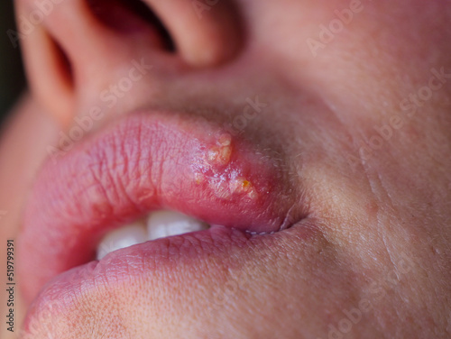 Tablou pe pânză CLOSE UP: Detailed view of herpes simplex on upper lip caused by immune weakness