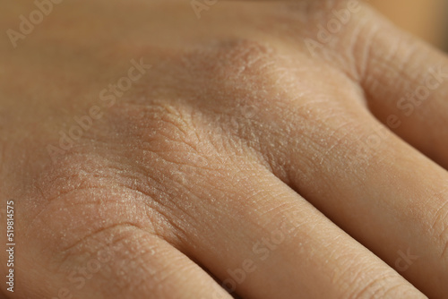 Closeup view of person with dry skin on hand