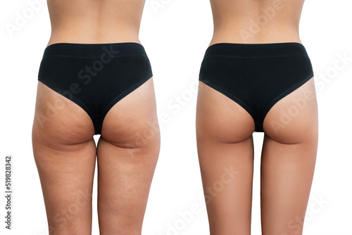 Young woman's thighs with cellulite before and after treatment isolated on white background. Getting rid of excess weight. Result of diet, sports, massage, scrub, wellness. Improving the skin on legs
