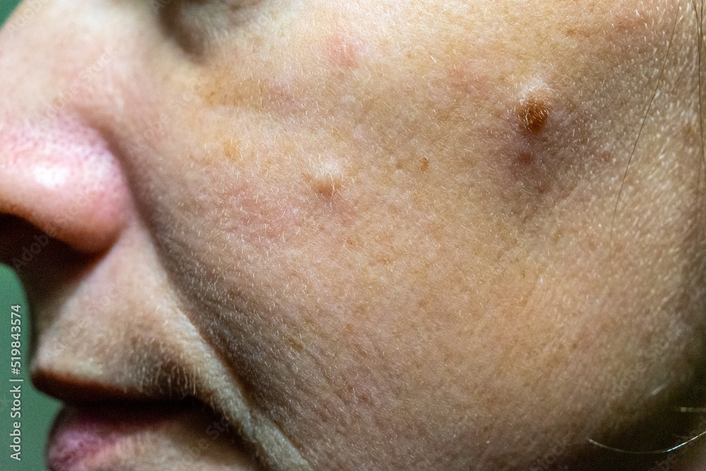 Close-up of a woman's cheek with problem skin Close-up of a woman's cheek with problem skin