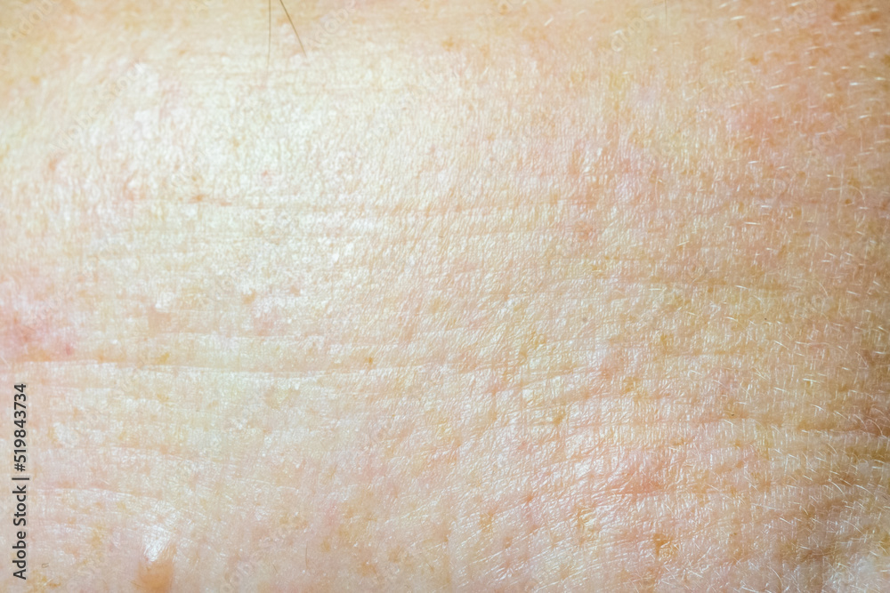 Fototapeta premium The forehead of a woman with problematic skin. Clous up