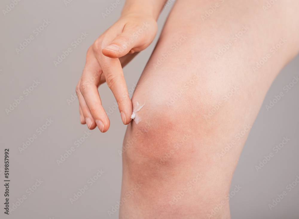 Woman putting pain relieving cream on knee. Leg injury concept. Sprained ligaments, meniscus tear, tendinitis. Health problems, medical conditions. High quality photo Woman putting pain relieving cream on knee. Leg injury concept. Sprained ligaments, meniscus tear, tendinitis. Health problems, medical conditions. High quality photo
