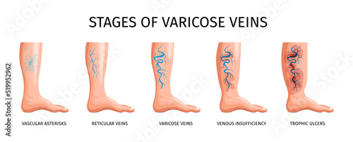 Stages Of Varicose Veins