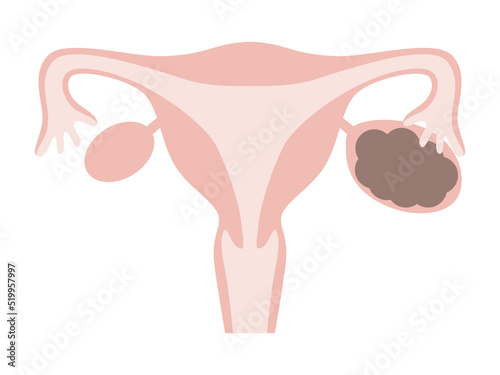 チョコレート嚢胞