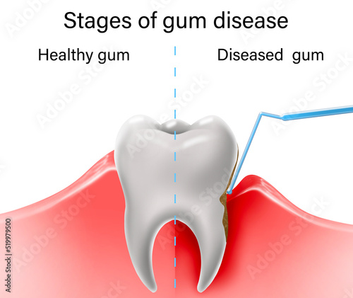 Collage with illustrations of healthy tooth with gum and diseased ones. Gingivitis and periodontitis