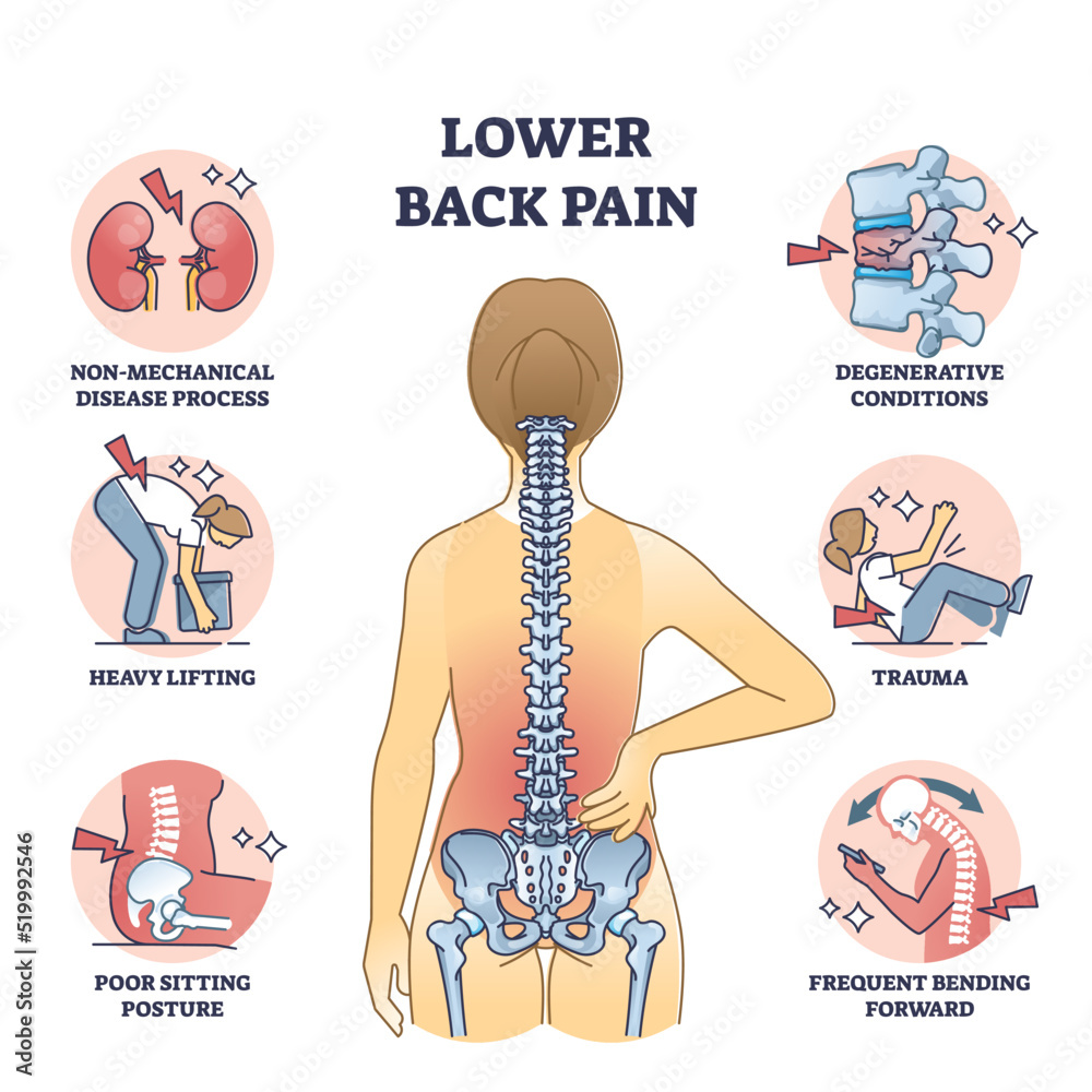 Vecteur Stock Lower back pain and painful body backbone skeleton causes  outline diagram. Labeled educational scheme with explanation of medical  condition after disease process or sitting posture vector illustration |  Adobe Stock