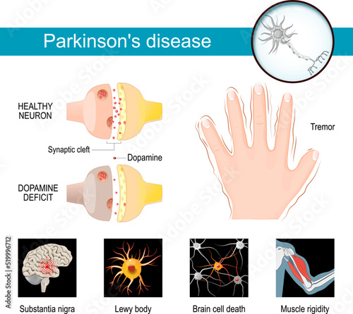Parkinson's disease Infographic. Symptoms of a parkinsonism. photo
