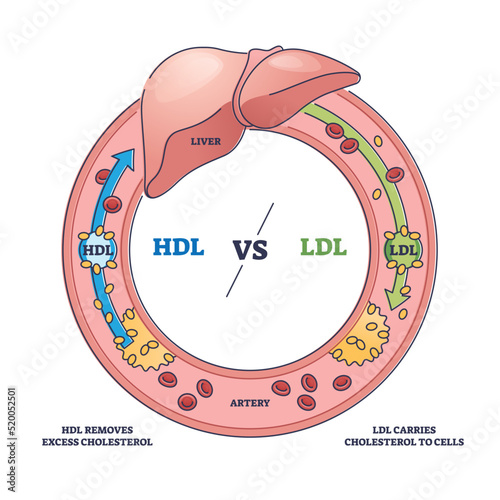 Good HDL and bad LDL cholesterol movement comparison outline diagram. Labeled educational scheme with liver function and fat cells flow to cells vector illustration. Artery disease risk explanation. photo