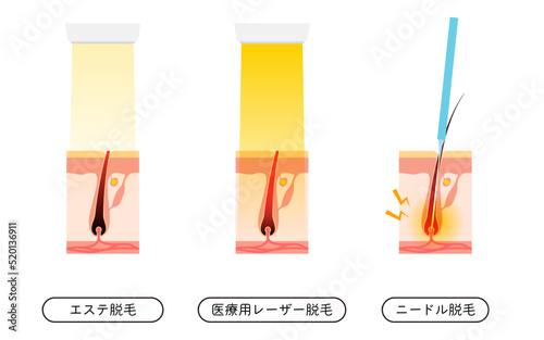 脱毛のイメージ、エステ脱毛・医療用レーザー脱毛・ニードル脱毛
