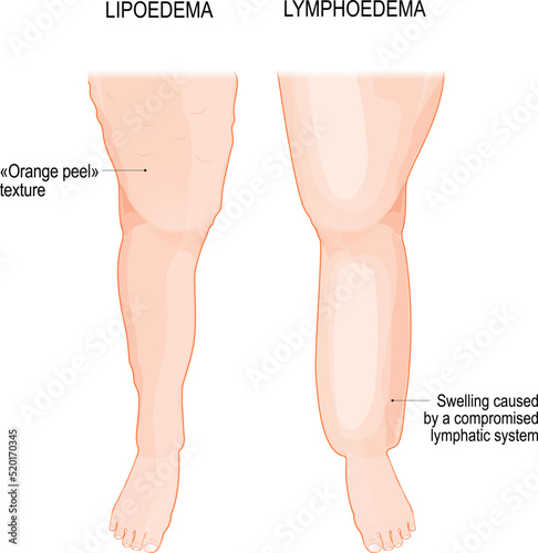 Lymphedema and Lipoedema. Comparison and difference. Overweight problem. photo