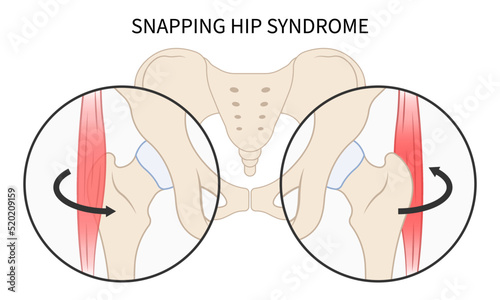 torn of tensor tendon hip coxa saltans flexor stretch Pain rectus bursae Intra groin broken strain iliacus psoas major band Joint tear thigh tract labral femur Injury Muscle greater trauma Labrum