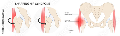 groin pain of hip tendon Injury coxa saltans flexor stretch rectus bursae Intra broken strain iliacus psoas torn major band Joint tear thigh tract labral tensor femur muscle greater trauma Labrum