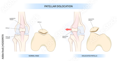 The anatomy of patellar dislocated and subluxation patella dysplasia Painful Joint photo