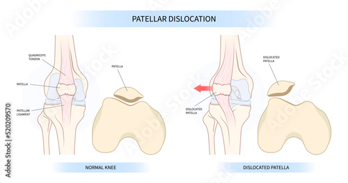 The anatomy of patellar dislocated and subluxation patella dysplasia Painful Joint