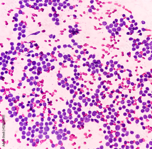 Cervical lymph node cytology: Lymphoproliferative disorder favor Non-Hodgkin's lymphoma. Smear show cellular material of monotonous population of atypical lymphocytes.