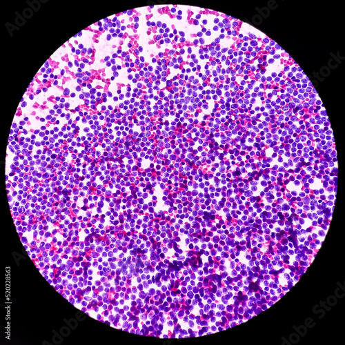 Cervical lymph node cytology: Lymphoproliferative disorder favor Non-Hodgkin's lymphoma. Smear show cellular material of monotonous population of atypical lymphocytes.