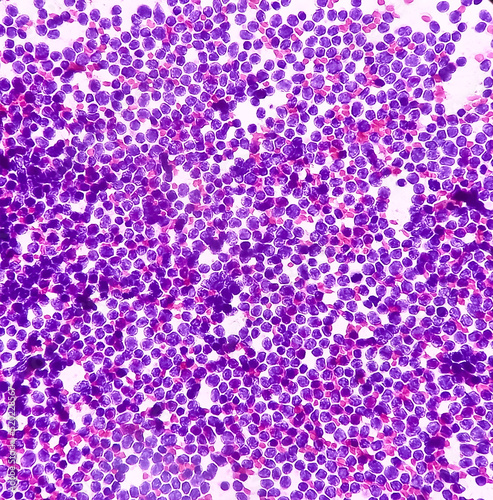 Cervical lymph node cytology: Lymphoproliferative disorder favor Non-Hodgkin's lymphoma. Smear show cellular material of monotonous population of atypical lymphocytes. photo