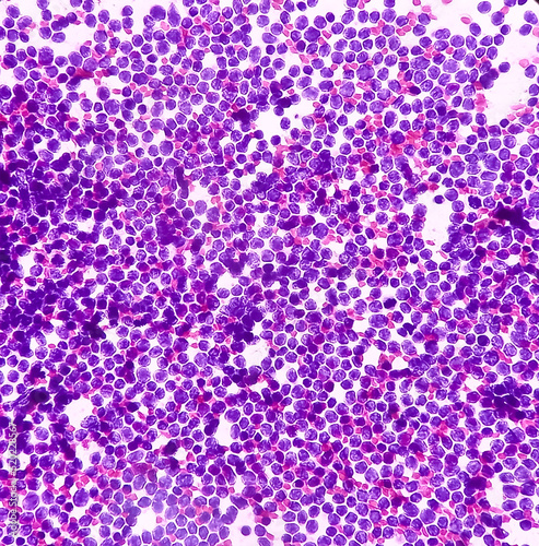 Cervical lymph node cytology: Lymphoproliferative disorder favor Non-Hodgkin's lymphoma. Smear show cellular material of monotonous population of atypical lymphocytes.