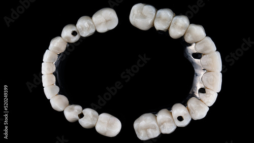 dental composition of two titanium bars and ceramic crowns, top view on a black background