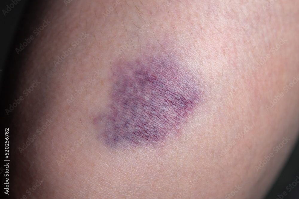 Image of the bruise on woman leg Image of the bruise on woman leg