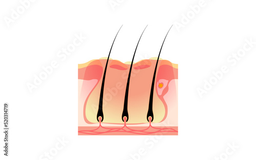 毛包炎が悪化した複数のせつが皮下でつながった「よう」の図解イラスト