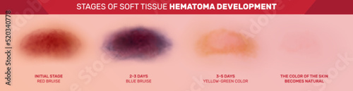 Hematoma Development Stages Set