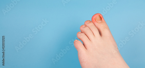 Ingrown Toenail Problem. Infected Foot Check. Podiatry Patient. Treats ingrown nail. Concept body care. injured toenail in, close up banner image on blue background. Nail problem