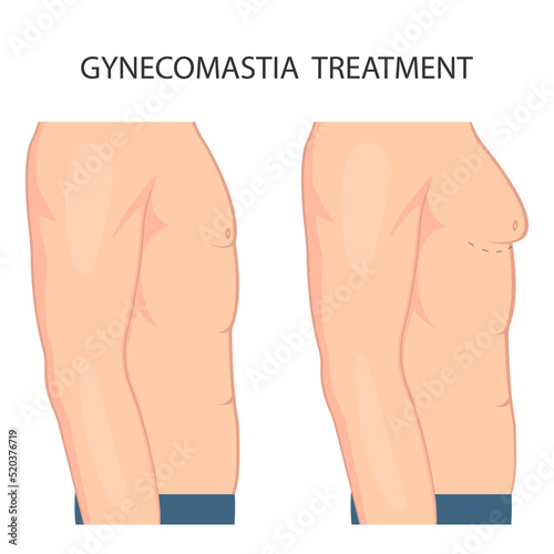 Vector illustration of gynecomastia in men. For advertising cosmetic plastic procedures 