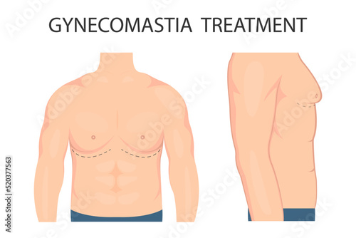 Vector illustration of gynecomastia in men. For advertising cosmetic plastic procedures