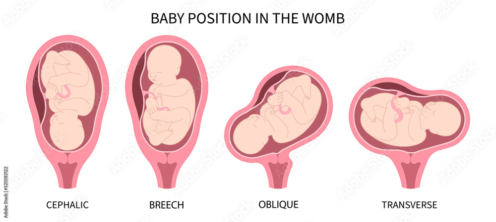 Fetal In Womb Labor C Section Praevia Mother Twins Cord Hip Lie Bone fetal-in-womb-labor-c-section-praevia-mother-twins-cord-hip-lie-bone