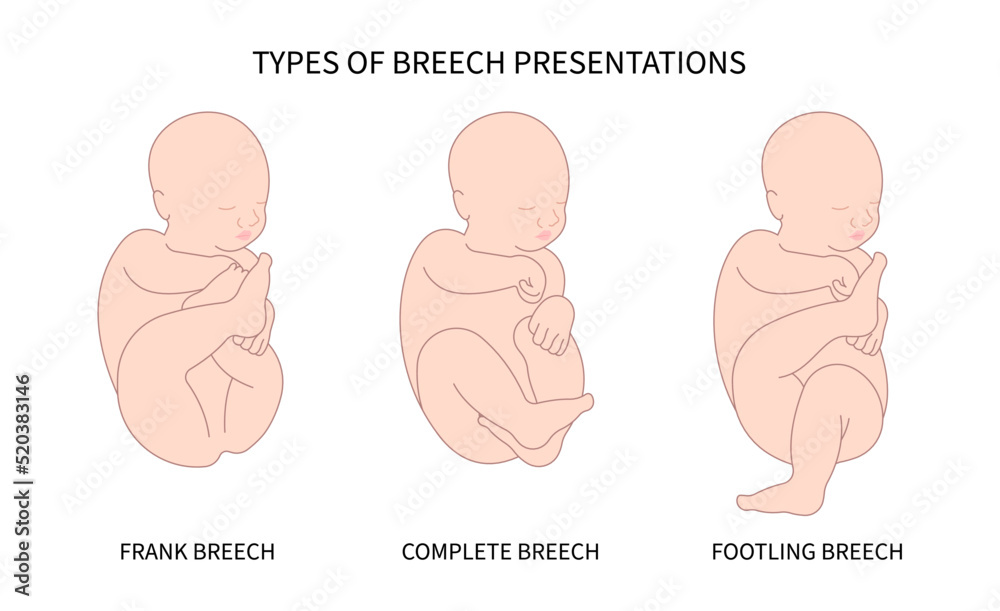Labor C section of praevia Mother twins cord hip lie bone fetal Baby born Head Down canal Left womb Right spine pelvis cervix score birth Breech defect vertex Exam uterus Frank Bishop weeks Infant Labor C section of praevia Mother twins cord hip lie bone fetal Baby born Head Down canal Left womb Right spine pelvis cervix score birth Breech defect vertex Exam uterus Frank Bishop weeks Infant