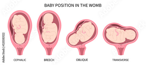 Fotografie, Obraz fetal in womb Labor C section praevia Mother twins cord hip lie bone Baby born H