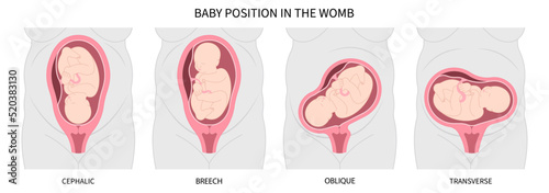 Baby Head Down Breech Labor C section praevia Mother twins cord hip lie bone fetal born canal Left womb Right spine pelvis cervix score birth defect vertex Exam uterus Frank Bishop weeks Infant