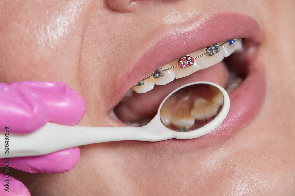 Dental procedure for installing braces close up.The procedure for the