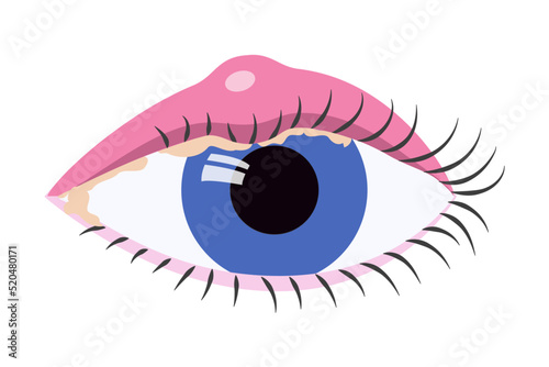 Human eye with swelled eyelid. Blepharitis. Eyeball inflammation medical llustration.