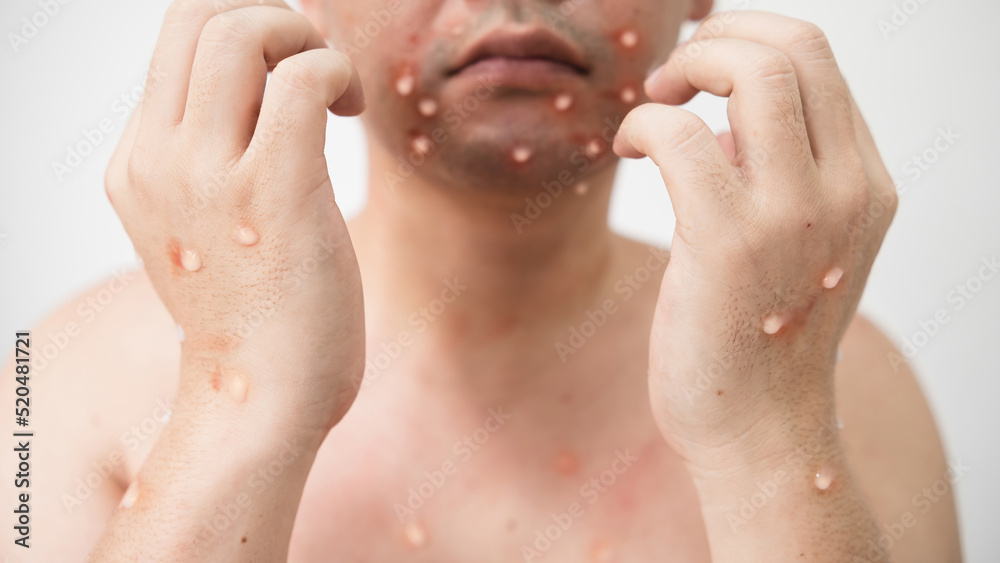 Concept of monkey pox infection, a white Asian man with pustular skin from monkeypox virus infection. Concept of monkey pox infection, a white Asian man with pustular skin from monkeypox virus infection.