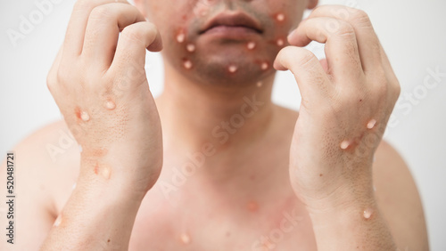 Concept of monkey pox infection, a white Asian man with pustular skin from monkeypox virus infection.