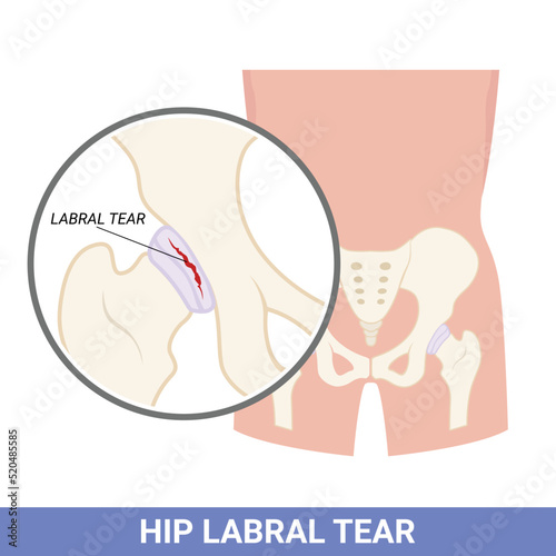 The labral of hip that tear and injury the disorder in medical photo